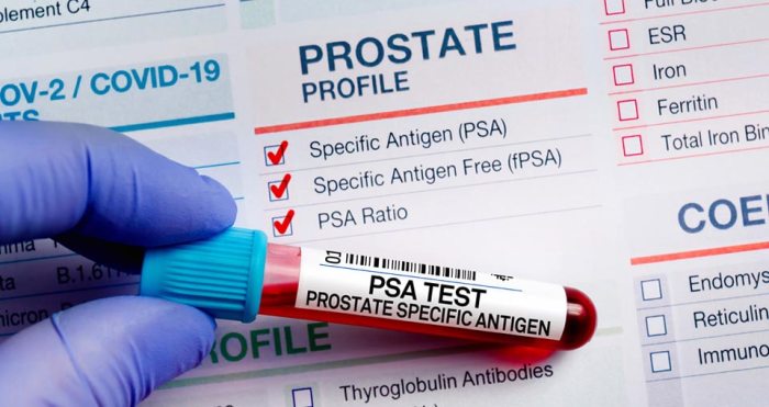 Psa prostate concentration specific blood antigen sometimes screening possible test used solved